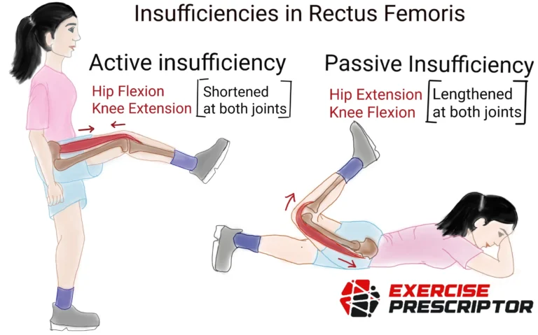 Insufficiencies of the rectus femoris