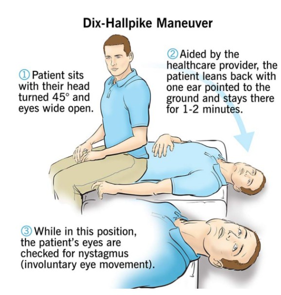 dix-hallpike maneuver