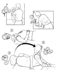 epley manoeuvre procedure
