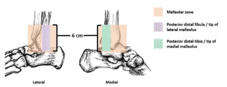 ottawa ankle rule