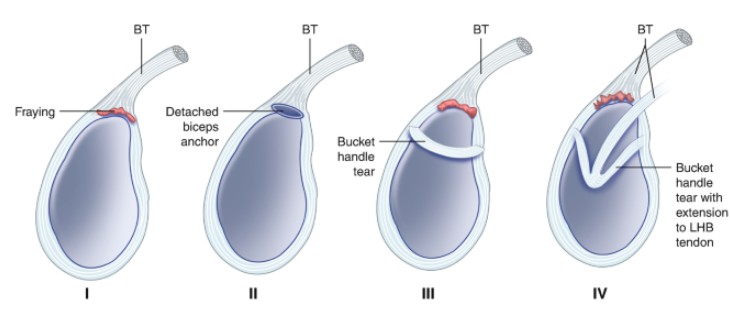 what is slap tear