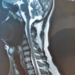 radiculopathy case study