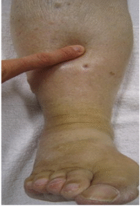 Congestive heart failure