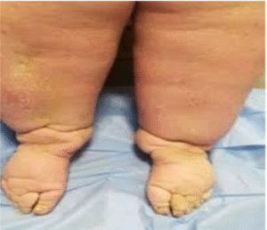 Lymphedema