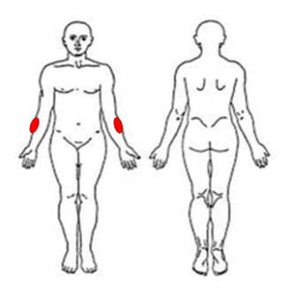 Degenerative Lateral