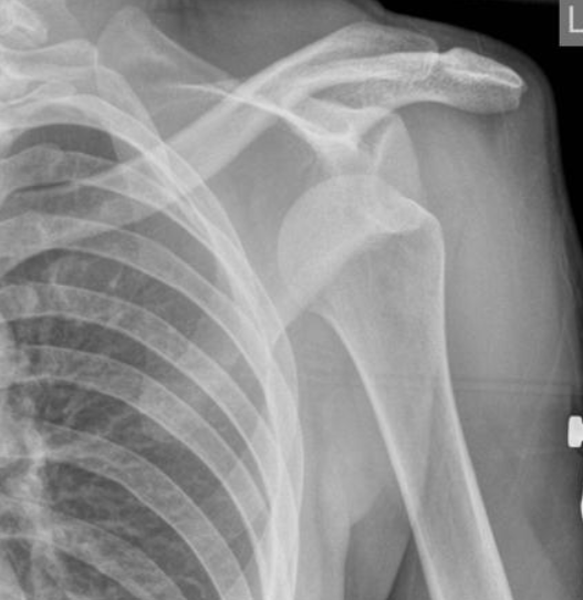 X - ray recurrrent shoulder dislocation