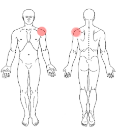 pain analysis recurrent shoulder dislocation